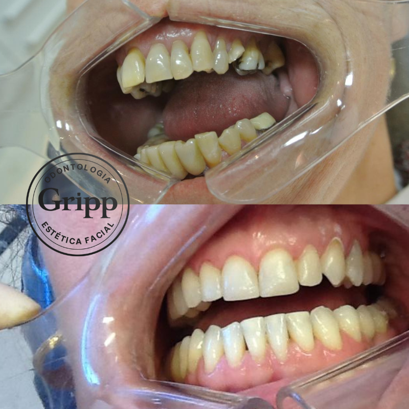 Invisalign Antes e Depois